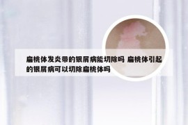 扁桃体发炎带的银屑病能切除吗 扁桃体引起的银屑病可以切除扁桃体吗