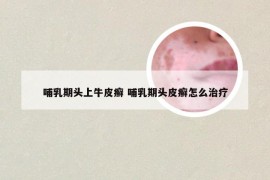 哺乳期头上牛皮癣 哺乳期头皮癣怎么治疗