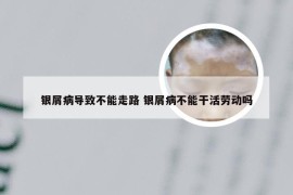 银屑病导致不能走路 银屑病不能干活劳动吗