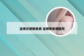 淄博沂源银屑病 淄博银屑病医院