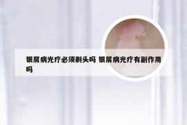 银屑病光疗必须剃头吗 银屑病光疗有副作用吗