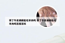 得了牛皮病癣能吃羊肉吗 得了牛皮病癣能吃羊肉吗百度百科