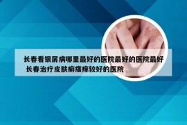 长春看银屑病哪里最好的医院最好的医院最好 长春治疗皮肤癣瘙痒较好的医院