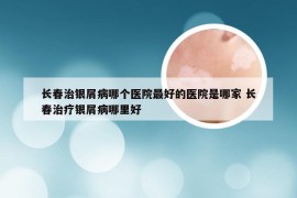 长春治银屑病哪个医院最好的医院是哪家 长春治疗银屑病哪里好