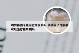 喝转移因子能治愈牛皮癣吗 转移因子口服液可以治疗银屑病吗