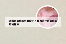 运城银屑病医院治疗好了 山西治疗银屑病最好的医生