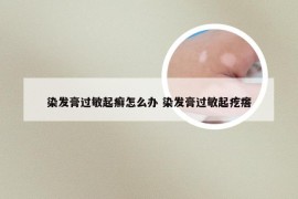 染发膏过敏起癣怎么办 染发膏过敏起疙瘩