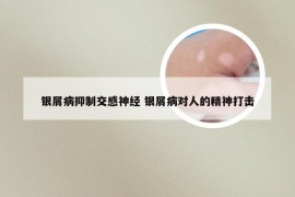 银屑病抑制交感神经 银屑病对人的精神打击