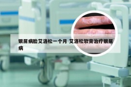 银屑病脸艾洛松一个月 艾洛松软膏治疗银屑病