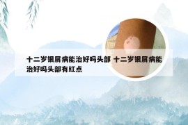 十二岁银屑病能治好吗头部 十二岁银屑病能治好吗头部有红点