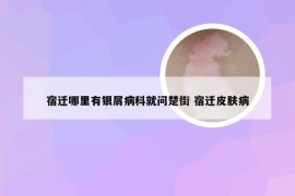 宿迁哪里有银屑病科就问楚街 宿迁皮肤病
