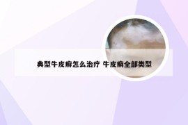 典型牛皮癣怎么治疗 牛皮癣全部类型