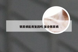 银屑病能用复因吗 复合银屑病