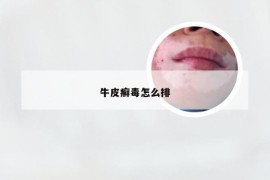 牛皮癣毒怎么排