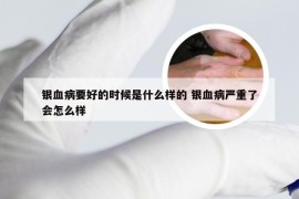 银血病要好的时候是什么样的 银血病严重了会怎么样