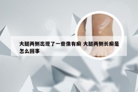 大腿两侧出现了一些像有癣 大腿两侧长癣是怎么回事