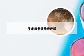 牛皮癣紫外线光疗后