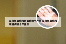 反向银屑病和银屑病哪个严重 反向银屑病和银屑病哪个严重些