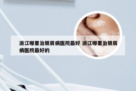 浙江哪里治银屑病医院最好 浙江哪里治银屑病医院最好的