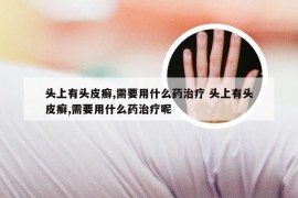 头上有头皮癣,需要用什么药治疗 头上有头皮癣,需要用什么药治疗呢