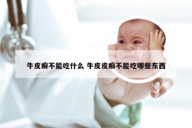 牛皮癣不能吃什么 牛皮皮癣不能吃哪些东西