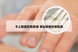 手上脓疱型银屑病 掌趾脓疱性银屑病