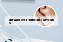 银屑病跟新冠肺炎 银屑病和什么病的症状相似