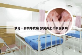 梦见一脚的牛皮癣 梦见身上长牛皮肤病