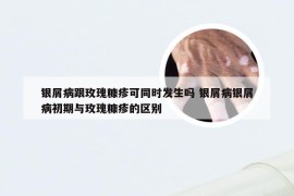 银屑病跟玫瑰糠疹可同时发生吗 银屑病银屑病初期与玫瑰糠疹的区别