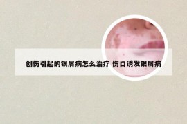 创伤引起的银屑病怎么治疗 伤口诱发银屑病