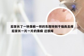 后背长了一块像癣一样的东西特别干燥而且痒 后背长一片一片的像癣 还很痒