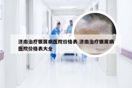 济南治疗银屑病医院价格表 济南治疗银屑病医院价格表大全