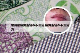 银屑病麻黄连轺赤小豆汤 麻黄连轺赤小豆汤方