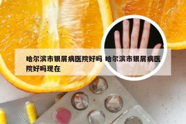 哈尔滨市银屑病医院好吗 哈尔滨市银屑病医院好吗现在