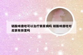 硝酸咪康唑可以治疗银屑病吗 硝酸咪康唑对皮肤有损害吗