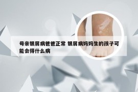 母亲银屑病爸爸正常 银屑病妈妈生的孩子可能会得什么病
