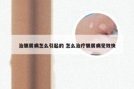 治银屑病怎么引起的 怎么治疗银屑病见效快