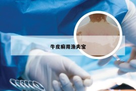牛皮癣用渔夫宝