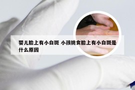 婴儿脸上有小白斑 小孩挑食脸上有小白斑是什么原因