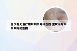 重庆有无治疗银屑病的专科医院 重庆治疗银屑病好的医院