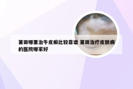 莆田哪里治牛皮癣比较靠谱 莆田治疗皮肤病的医院哪家好
