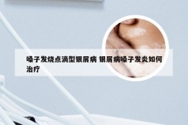 嗓子发烧点滴型银屑病 银屑病嗓子发炎如何治疗