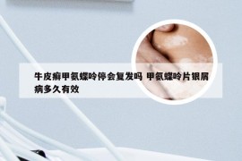 牛皮癣甲氨蝶呤停会复发吗 甲氨蝶呤片银屑病多久有效