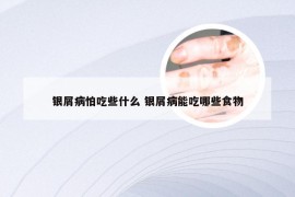 银屑病怕吃些什么 银屑病能吃哪些食物