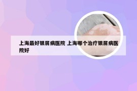 上海最好银屑病医院 上海哪个治疗银屑病医院好