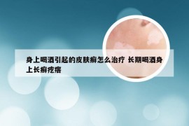 身上喝酒引起的皮肤癣怎么治疗 长期喝酒身上长癣疙瘩