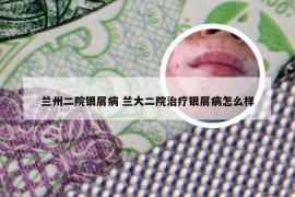 兰州二院银屑病 兰大二院治疗银屑病怎么样