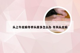 头上牛皮癣冬季头屑多怎么办 冬天头皮癣