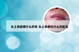 头上有藓摸什么药膏 头上有癣吃什么药能治