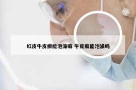 红皮牛皮癣能泡澡嘛 牛皮廨能泡澡吗